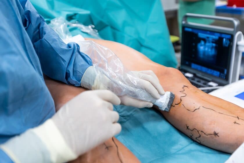 Advanced medical technology for varicose vein treatment